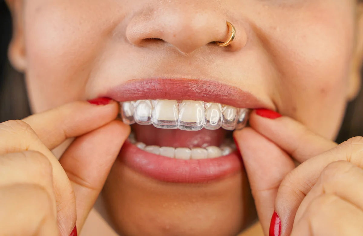 Close-up of a woman placing a clear aligner tray onto her upper teeth